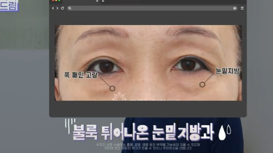 이번 명절 선물은 며느리 몰래 젊어지는 중년성형으로 하세요 사진 10