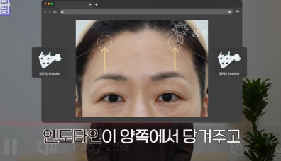 더 새로워지고 더 강력해진, 꼭 알아야하는 2026 중년성형트렌드 사진 20