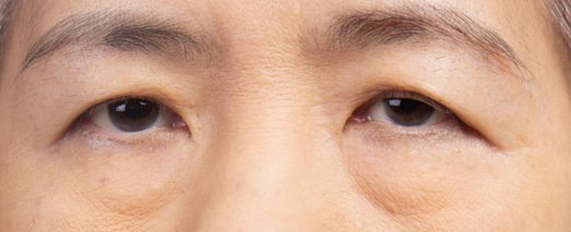 강남 상안검 잘하는 곳?하안검·눈성형 추천 성형외과를 챗지피티에게 물어봤다 사진 6