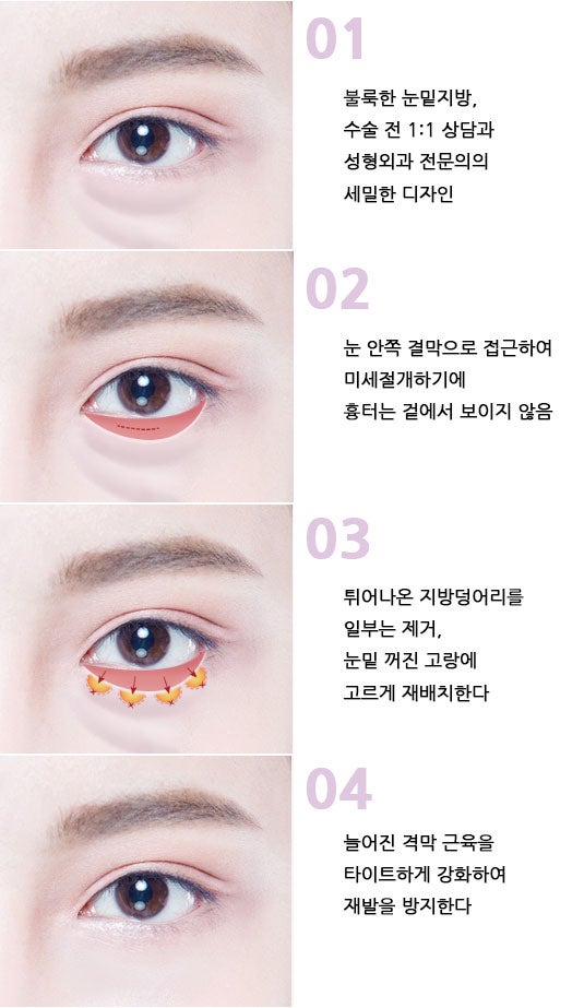 강남 상안검 잘하는 곳?하안검·눈성형 추천 성형외과를 챗지피티에게 물어봤다 사진 5