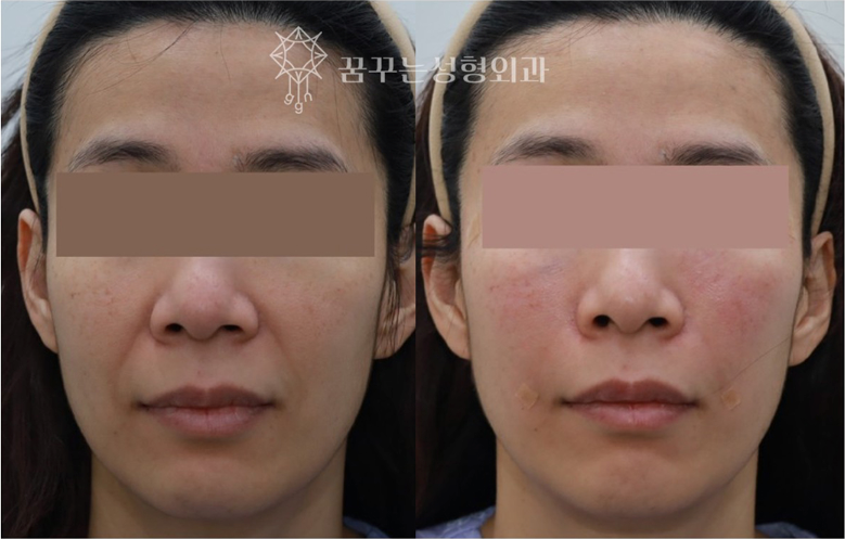 팔자주름 실리프팅 효과 있을까? 꿈꾸는 성형외과 ‘꿈프팅’으로 달라지는 이유