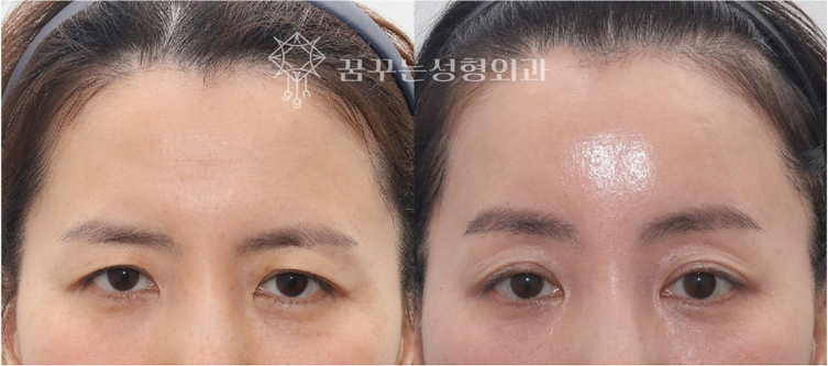 강남 내시경 이마거상 잘하는 곳 찾는다면? 자연스러운 눈매 개선, 꿈꾸는 성형외과 사진 6