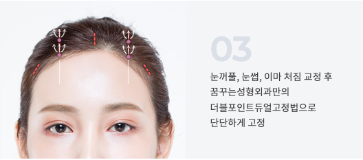 강남 내시경 이마거상 잘하는 곳 찾는다면? 자연스러운 눈매 개선, 꿈꾸는 성형외과 사진 5