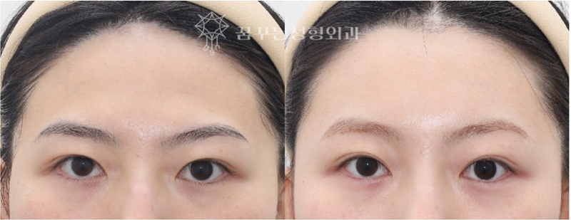 강남 내시경 이마거상 잘하는 곳 찾는다면? 자연스러운 눈매 개선, 꿈꾸는 성형외과 사진 9