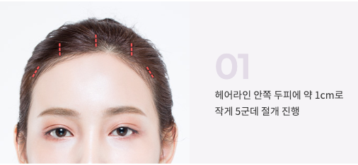 강남 내시경 이마거상 잘하는 곳 찾는다면? 자연스러운 눈매 개선, 꿈꾸는 성형외과 사진 3