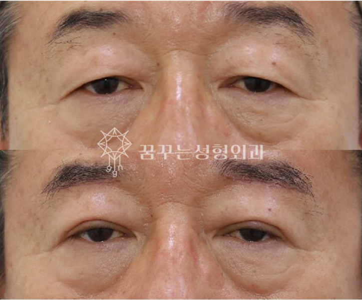 중년 남성 안티에이징 필수 수술눈밑지방재배치, 상안검, 하안검 차이와 효과 사진 7