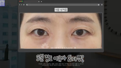 이번 연휴, 남들 쉴 때 예뻐질 결심! 기간별 성형족보총정리(feat.어버이날 선물)