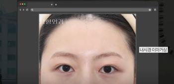 이번 연휴, 남들 쉴 때 예뻐질 결심! 기간별 성형족보총정리(feat.어버이날 선물) 사진 22