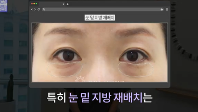이번 연휴, 남들 쉴 때 예뻐질 결심! 기간별 성형족보총정리(feat.어버이날 선물) 사진 12