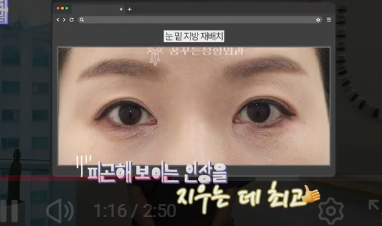 이번 연휴, 남들 쉴 때 예뻐질 결심! 기간별 성형족보총정리(feat.어버이날 선물) 사진 13