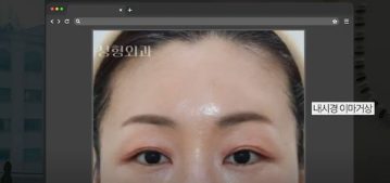 이번 연휴, 남들 쉴 때 예뻐질 결심! 기간별 성형족보총정리(feat.어버이날 선물) 사진 24