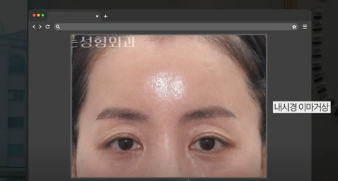 이번 연휴, 남들 쉴 때 예뻐질 결심! 기간별 성형족보총정리(feat.어버이날 선물) 사진 26