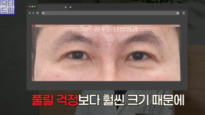 "진작 할걸" 싶은 남자상안검 한끗차이, 사진으로 확인하세요. 사진 14