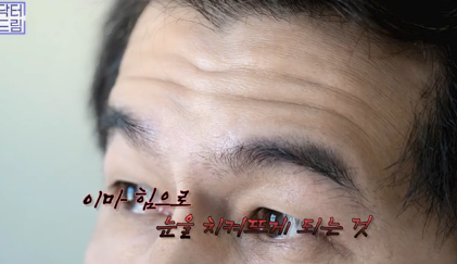 "진작 할걸" 싶은 남자상안검 한끗차이, 사진으로 확인하세요. 사진 3