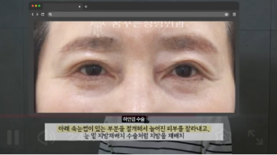 유형별로 다른 눈밑지방재배치 핵심가이드, 실패하는 이유 알고 가세요