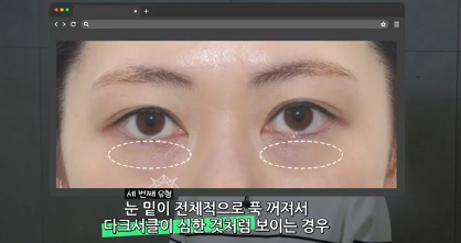 유형별로 다른 눈밑지방재배치 핵심가이드, 실패하는 이유 알고 가세요 사진 5