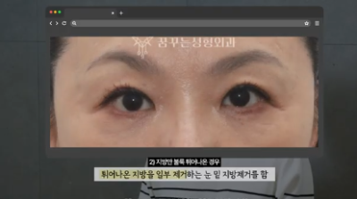 유형별로 다른 눈밑지방재배치 핵심가이드, 실패하는 이유 알고 가세요 사진 10