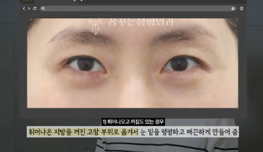 90%가 실패하는 눈밑지방재배치 4가지 이유 사진 4