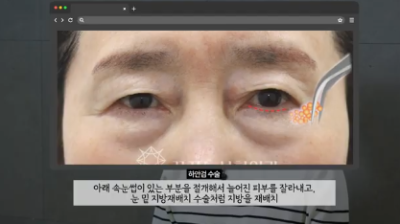90%가 실패하는 눈밑지방재배치 4가지 이유 사진 14
