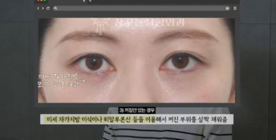 90%가 실패하는 눈밑지방재배치 4가지 이유 사진 8