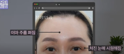 중년쌍꺼풀, 상안검 하면 안되는 눈이 있습니다! 사진 13