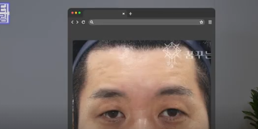 중년쌍꺼풀, 상안검 하면 안되는 눈이 있습니다! 사진 20