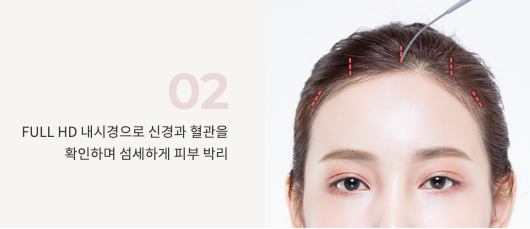 강남역 상안검 수술만으로 부족한 경우? 이마거상이 필요한 눈꺼풀 처짐 특징 사진 7