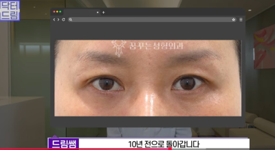 하안검 잘못하고 눈물 흘리는 친구 보고 깨달은 꿀팁 사진 20