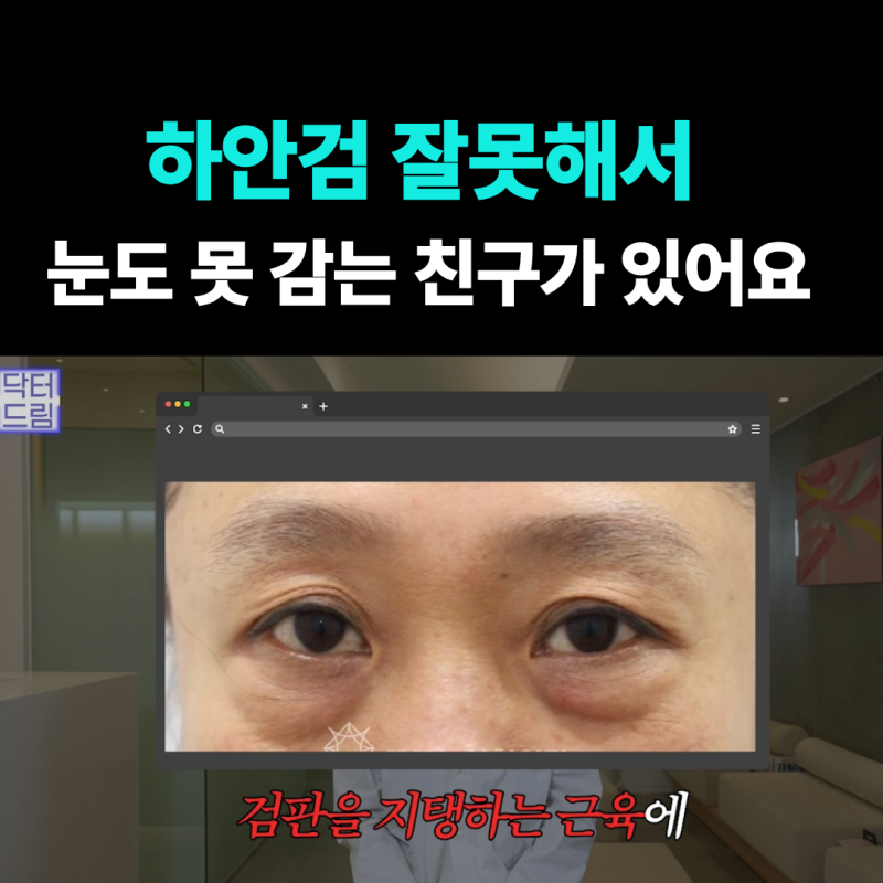 하안검 잘못하고 눈물 흘리는 친구 보고 깨달은 꿀팁 사진 4