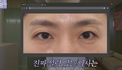 하안검 잘못하고 눈물 흘리는 친구 보고 깨달은 꿀팁 사진 7