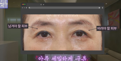 하안검 잘못하고 눈물 흘리는 친구 보고 깨달은 꿀팁 사진 10