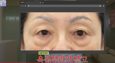 하안검 잘못하고 눈물 흘리는 친구 보고 깨달은 꿀팁 사진 13