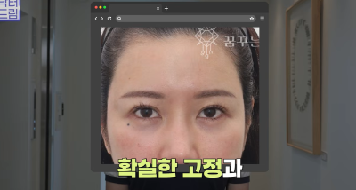 눈 성형 후 사나워진 얼굴, 딱 1가지가 똑같습니다 사진 23