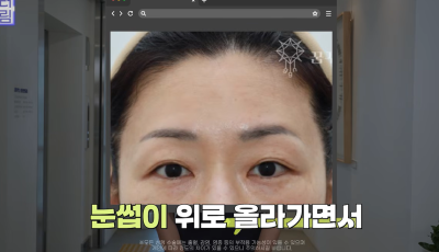 눈 성형 후 사나워진 얼굴, 딱 1가지가 똑같습니다 사진 9