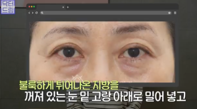 전현무도 한 중년수술, 이게 현실입니다 사진 24