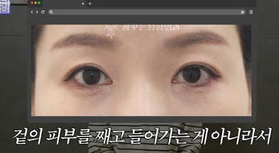 전현무도 한 중년수술, 이게 현실입니다 사진 23