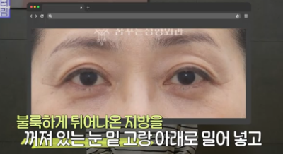 전현무도 한 중년수술, 이게 현실입니다 사진 25