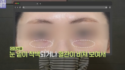 전현무도 한 중년수술, 이게 현실입니다