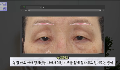 1000명 상안검수술 해준 의사가 아내는 안해준 이유 사진 18