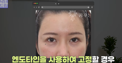 1000명 상안검수술 해준 의사가 아내는 안해준 이유 사진 24