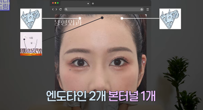 1000명 상안검수술 해준 의사가 아내는 안해준 이유 사진 25