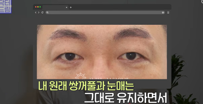 1000명 상안검수술 해준 의사가 아내는 안해준 이유 사진 20