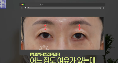 1000명 상안검수술 해준 의사가 아내는 안해준 이유 사진 16