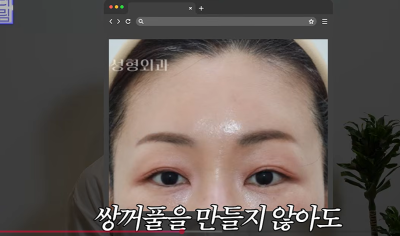 1000명 상안검수술 해준 의사가 아내는 안해준 이유 사진 12