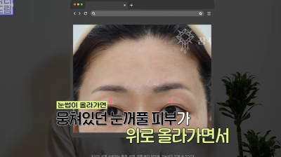 1000명 상안검수술 해준 의사가 아내는 안해준 이유 사진 11