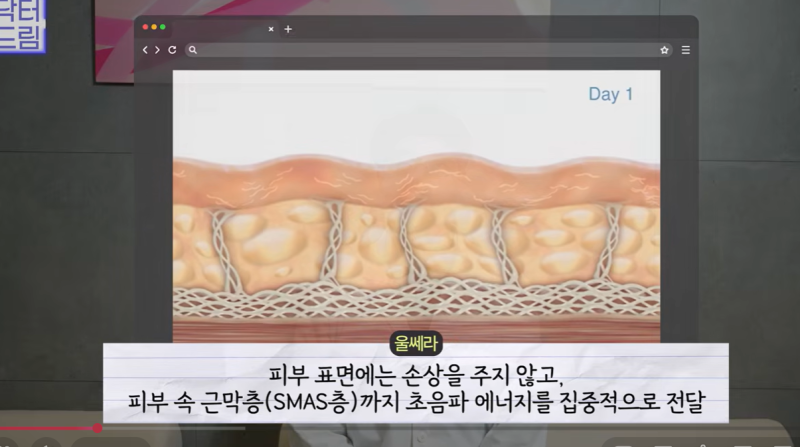 울쎄라 받다가 눈물 흘린 분들, 제발 이거 하고 광명 찾으세요 사진 4