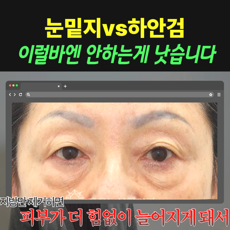 눈밑지vs하안검, 연예인A씨가 이걸 몰라서 잘못됐습니다