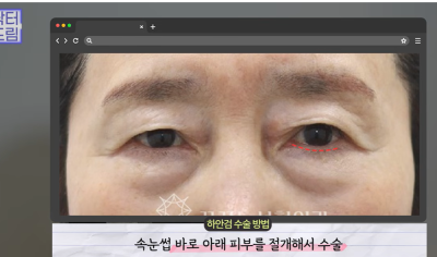 눈밑지vs하안검, 연예인A씨가 이걸 몰라서 잘못됐습니다 사진 22