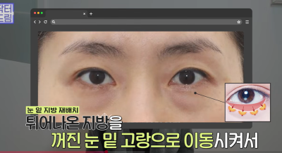 눈밑지vs하안검, 연예인A씨가 이걸 몰라서 잘못됐습니다 사진 14