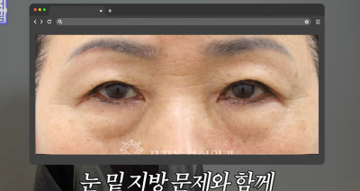 눈밑지vs하안검, 연예인A씨가 이걸 몰라서 잘못됐습니다 사진 26